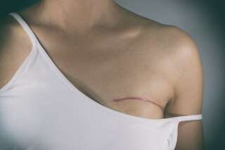 Certains cancers du sein présentent un risque de rechute pendant 20 ans