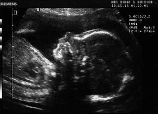 Des chercheurs italiens ont trouvé pour la première fois des particules de microplastiques dans des placentas de femmes enceintes (Photo d'illustration)