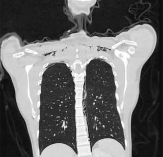 Image du scanner des poumons du jeune homme diagnostiqué d'une déchirure des poumons (pneumomédiastin).