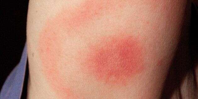 The pathognomonic erythematous rash in the pattern of a bullseye, which manifested at the site of a tick bite on a woman's posterior right upper arm. She subsequently contracted Lyme disease. Lyme disease patients who are diagnosed early, and receive prope