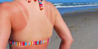 Si vous rosissez au lieu de bronzer, c'est la faute de vos gènes, pas de votre crème solaire (photo d'illustration)