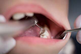 Un gel pour réparer l'émail des dents inventé par des chercheurs