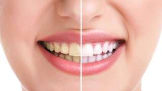 Avoir des dents jaunes est l'un des pires défauts d'un sourire pour plus d'un Français sur deux