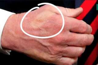 Emmanuel Macron a serré si fort la main de Donald Trump qu'il lui a imprimé la marque de son pouce