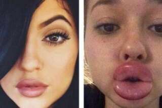 Le Kylie Jenner Challenge ou pourquoi les ados se gonflent les lèvres pour s'amuser