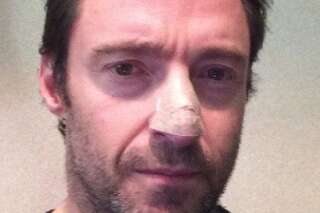 PHOTO. Hugh Jackman se soigne pour un cancer de la peau bénin