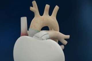 Cœur artificiel : nouvelle implantation 