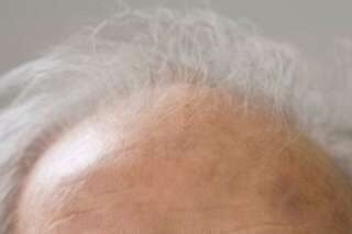 Perte des cheveux: des chercheurs en ont fait repousser en laboratoire