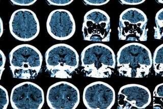 L'anomalie à l'origine de la maladie de Parkinson découverte par une équipe de chercheurs franco-belge