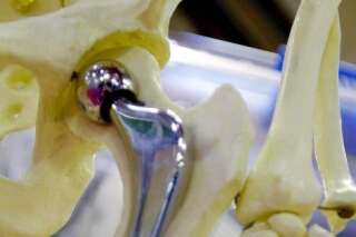 Affaire des prothèses défectueuses de la hanche : le fabricant Ceraver se défend