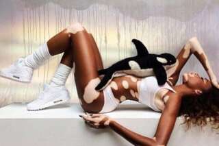 Vitiligo : Winnie Harlow la mannequin canadienne atteinte d'une maladie de peau