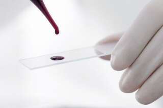 Le dépistage du cancer, bientôt possible grâce à un simple test sanguin?