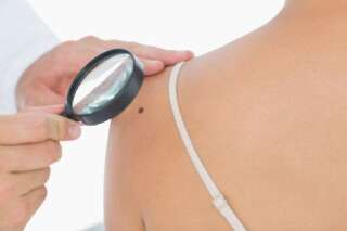 Cancer de la peau : Onze grains de beauté sur le bras droit ? Vous risquez un mélanome