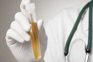 Dépistage du cancer du col de l'utérus : vers un test urinaire ?