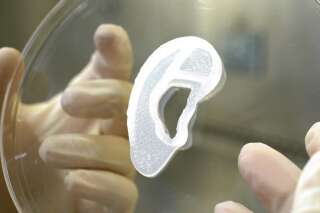 Un implant d'oreille imprimé à partir de cellules humaines greffé pour la première fois