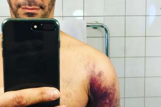 Ce selfie de Tomer Sisley l'épaule fracturée fait mal par procuration