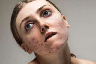 Pour accepter son acné, cette mannequin a lancé la campagne #FreeThePimple et libère la parole
