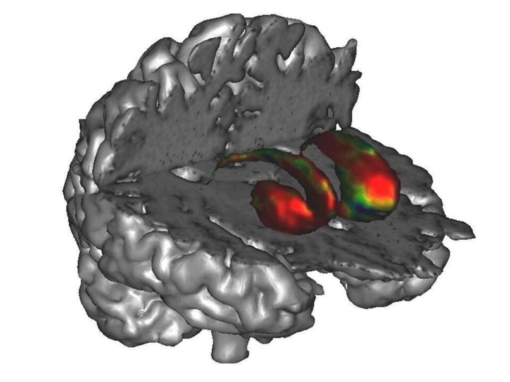 La maladie de Parkinson est une dégénerescence du cerveau - <a href="http://www.huffingtonpost.fr/philippe-remy/recherche-parkinson-france_b_3061767.html" target="_blank">Le mécanisme central de la maladie de Parkinson est la disparition accélérée de neurones</a> qui fabriquent la dopamine, celle-ci jouant en quelque sorte le rôle de l'huile dans un moteur en rendant les mouvements plus fluides, plus rapides et plus efficaces. Nous ne savons toujours pas comment interrompre ou ralentir de manière significative la dégénérescence de ces neurones. La recherche thérapeutique a pour l'instant réussi à remplacer la dopamine manquante, grâce aux médicaments, ou à compenser cette absence.