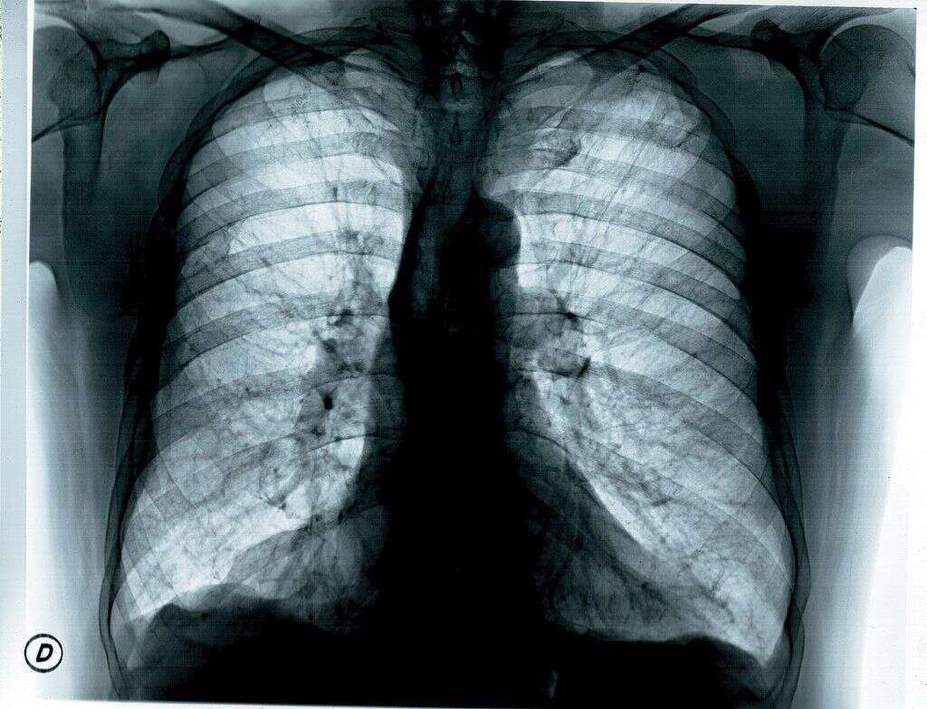 1979 : la tomographie - La tomographie est une technique d'imagerie médicale qui permet de reconstruire le volume d'un objet. Sans tomographie, pas d'IRM ou encore de scanners corporels. Si ça n'a pas changé la vie, la tomographie a permis de sauver des vies.