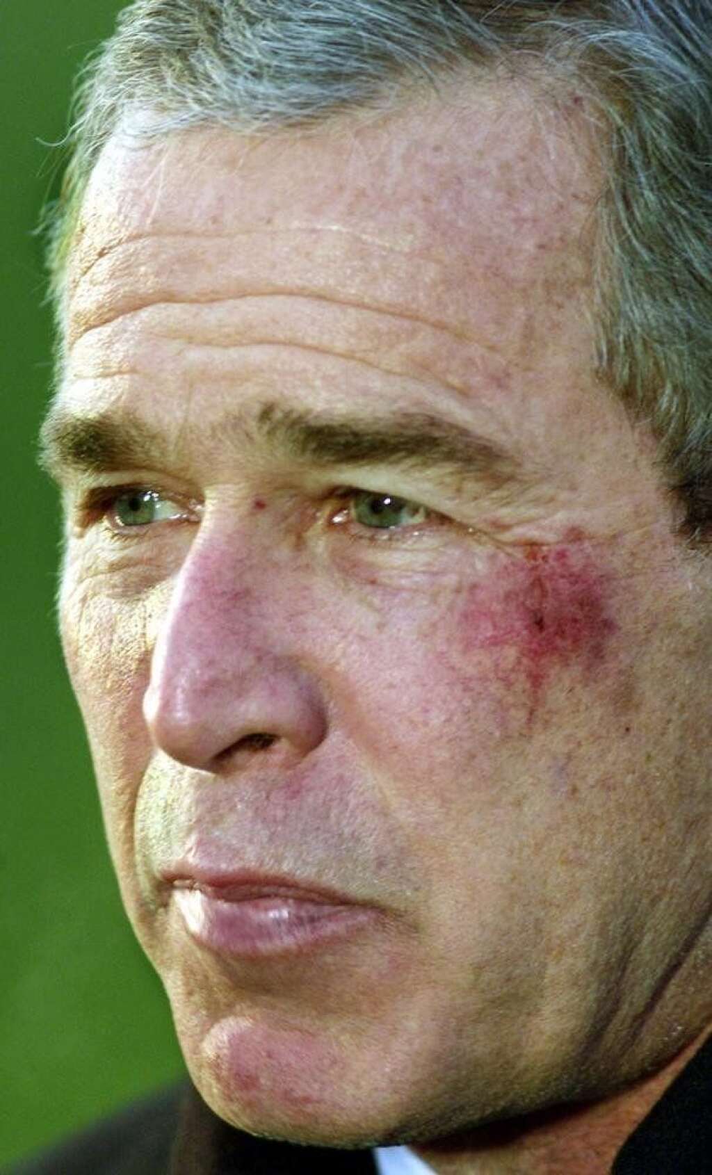 George W. Bush manque s'étouffer avec un bretzel - Cette belle ecchymose sur la joue gauche de l'ancien président est la conséquence d'une chute peu banale en janvier 2002. Alors qu'il regarde un match de football américain à la télévision, <a href="http://www.leparisien.fr/politique/etats-unis-bush-victime-d-un-bretzel-15-01-2002-2002736517.php" target="_blank">George W. Bush s'est évanoui à cause d'un bretzel avalé de travers</a>.