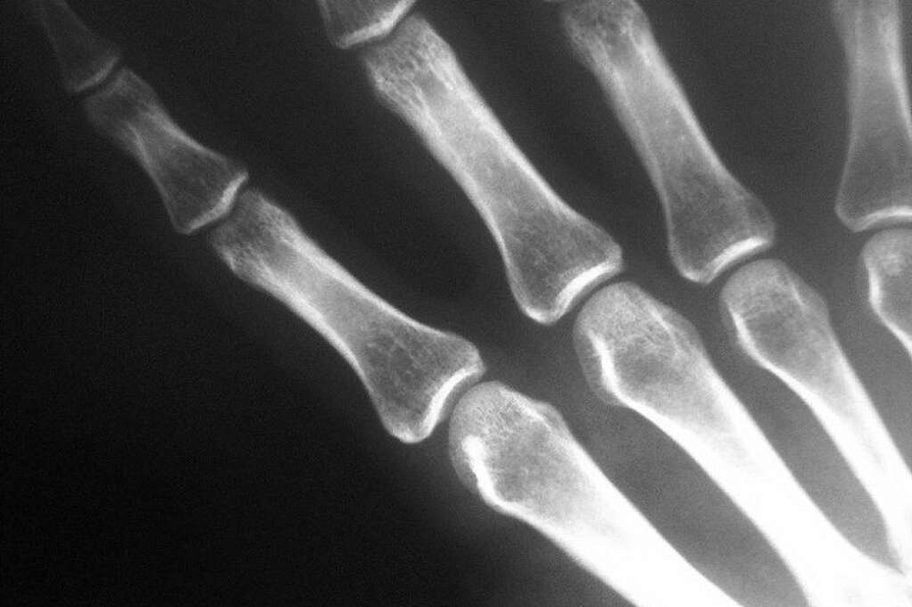 1901 : les rayons X - Les rayons découvertes par Röntgen ne sont autres que les rayons X, utilisés dans la majeure partie des radiographies. Tous ceux qui se sont cassés une jambe, un bras, une cheville ou un poignet en savent quelque chose.