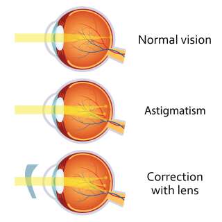 La cornée d'un astigmate est ovale, tandis que celle d'un non-astigmate est plus ronde.