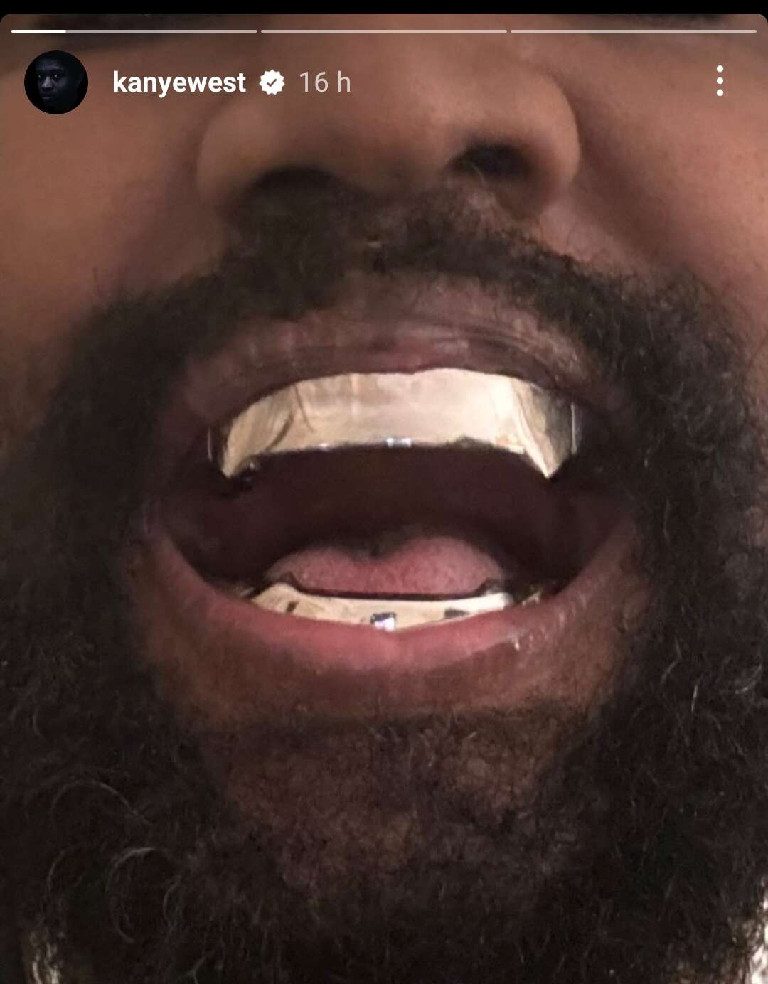Kanye West a ajouté à ses dents une prothèse en titane.