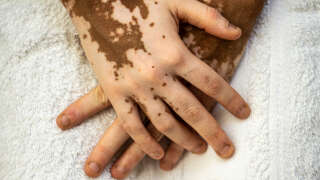 Details of skin tones on the hands of a young African woman with skin vitiligo,skin care and genetic melatonin change
